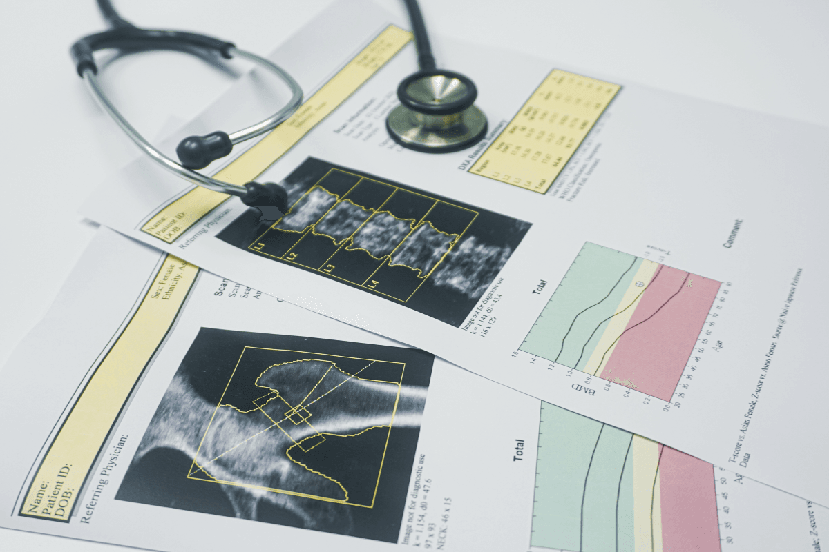 DEXA bone density scan results showing spine and hip measurements with T-score charts and stethoscope.